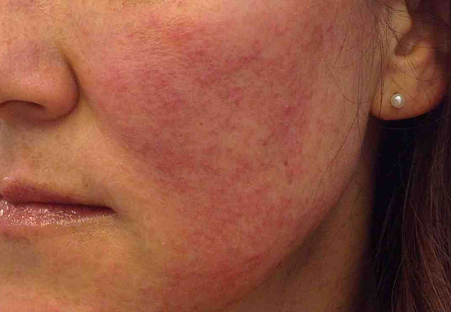 How to treat a allergic reaction rash on face