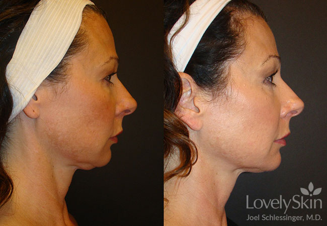 Omaha Cosmetic Surgery Ultherapy Skin Tightening Skin