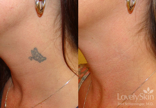 Omaha Cosmetic Surgery Tattoo Removal Skin Specialists Pc Lovelyskin