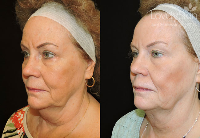 Kybella Chin Treatment