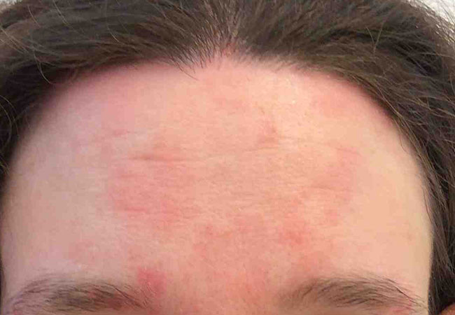 Alcohol Seizures Treatment: Eczema On Forehead Treatment