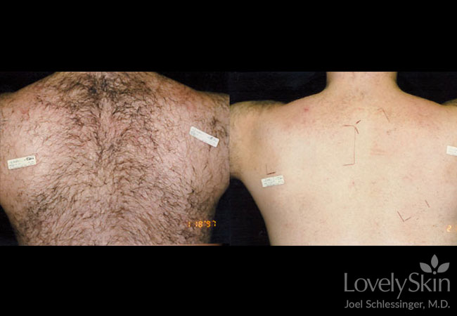 Laser Hair Removal Omaha Cosmetic Surgery Skin Specialists Pc Lovelyskin