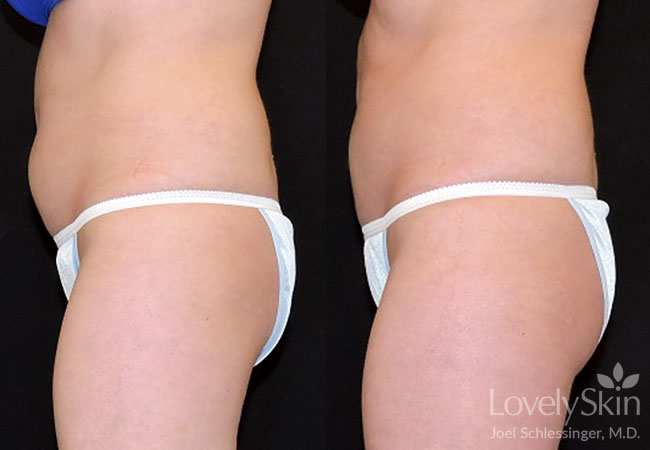 CoolSculpting Before and After