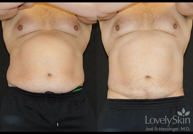 SmartLipo Before and After