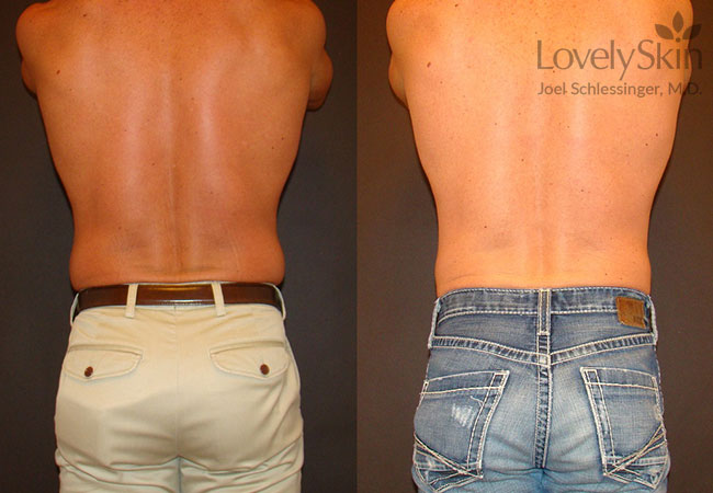 Coolsculpting Before And After Photos Skin Specialists Lovelyskin™