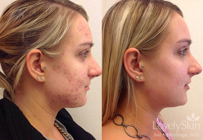 Acne Treatment