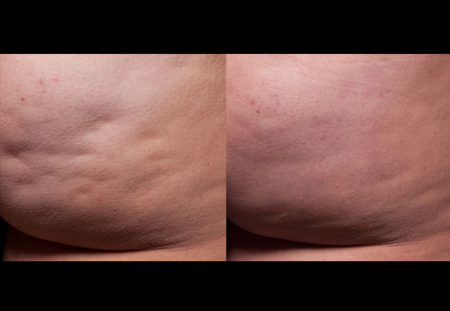 Cellfina Treatment Results, Courtesy of Dr. Joel Schlessinger, M.D., One Cellfina treatment after 3 months