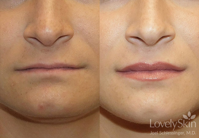 Botox Before and After - Left