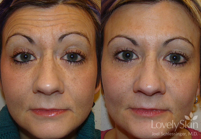 Omaha Cosmetic Surgery - BOTOX Treatments | Skin Specialists PC