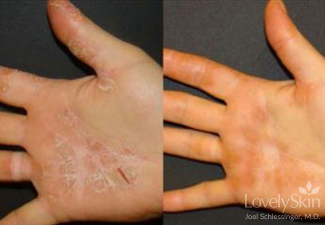 Omaha Dermatology - Eczema Treatments | Skin Specialists PC