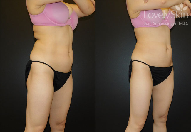 CoolSculpting Before and After