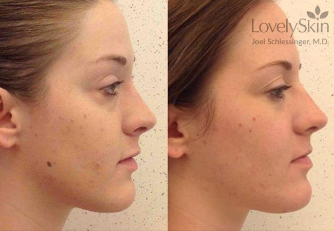 Facial Mole Removal Photos 105