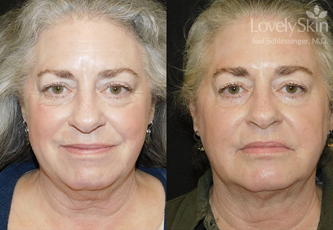 CoolSculpting Before and After