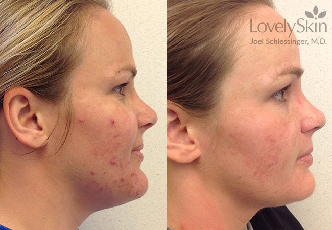 Acne Treatment