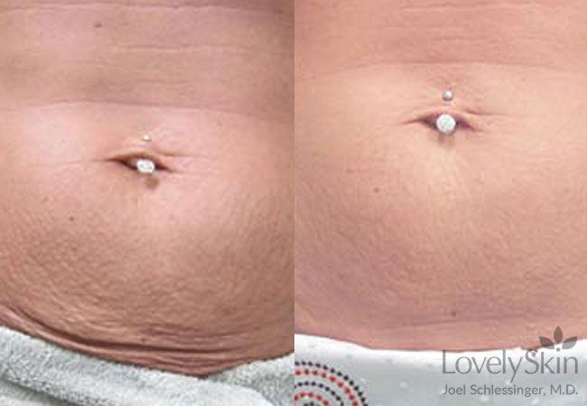 PelleFirm Before &amp; After Photos | Skin Specialists P.C.